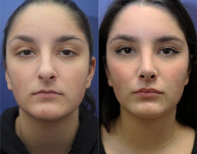 Lip Lift / Lip Augmentation Before & After Gallery - Patient 203349 - Image 1