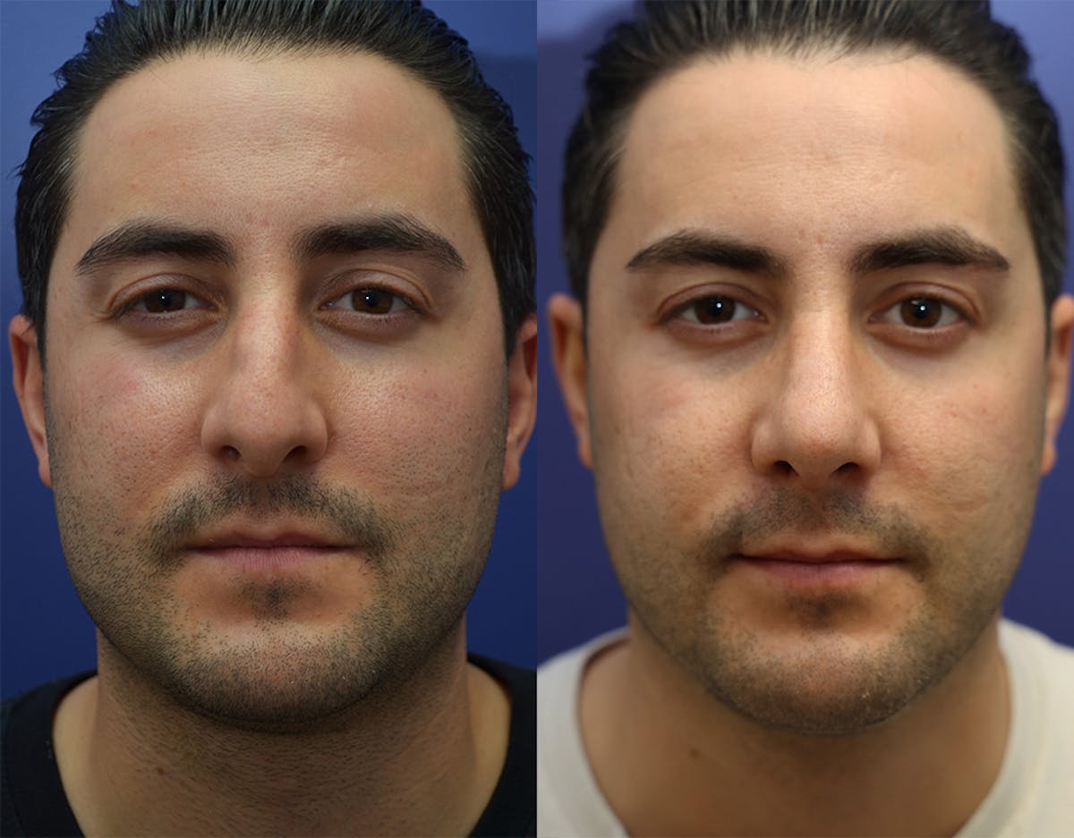 Rhinoplasty Before & After Gallery - Patient 283409 - Image 1