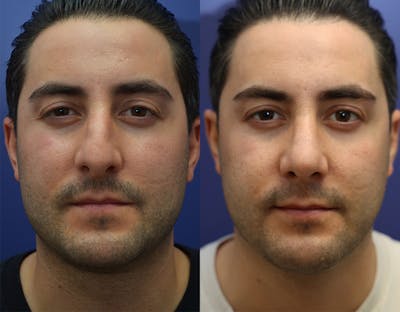 Rhinoplasty Before & After Gallery - Patient 283409 - Image 1