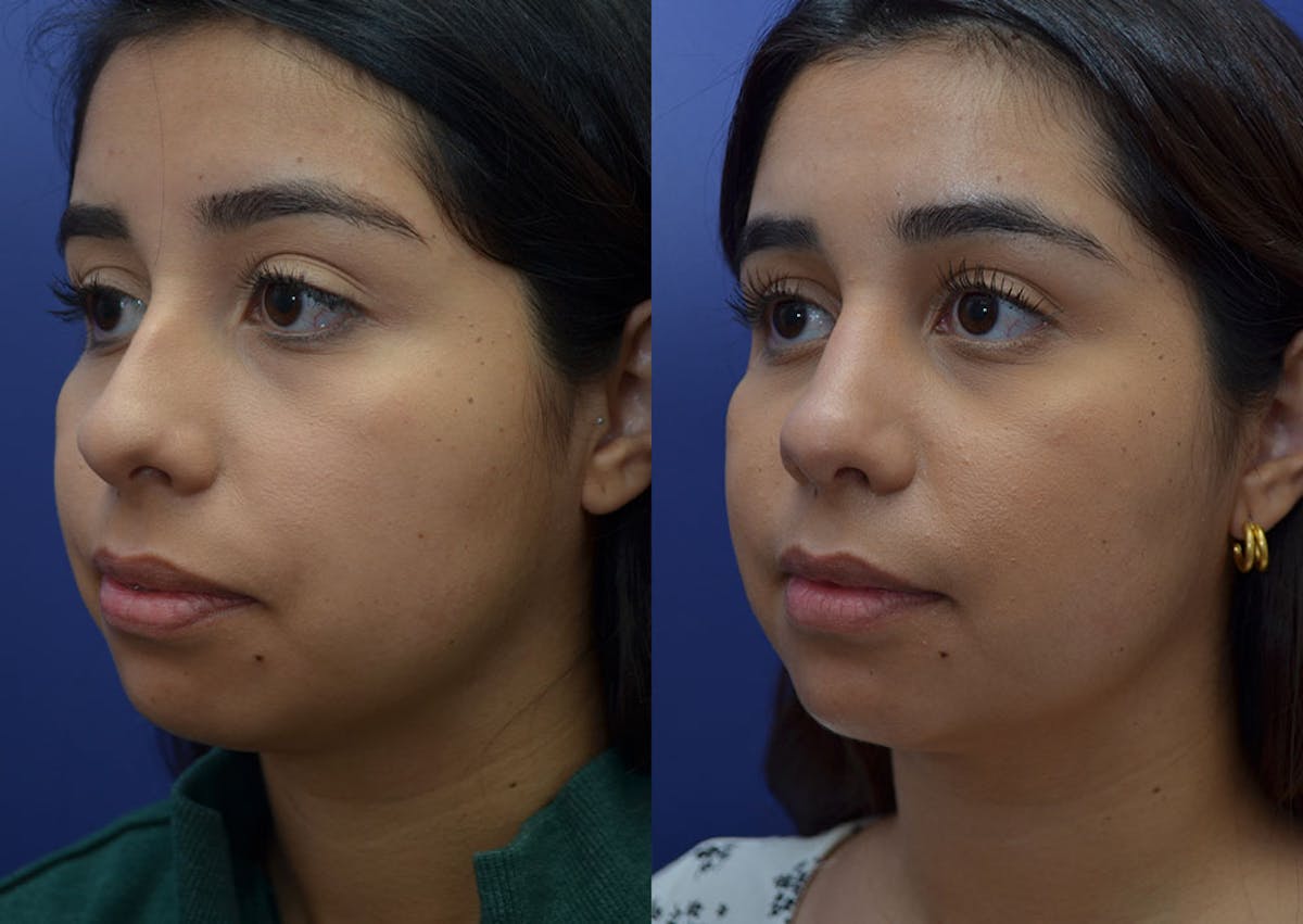 Rhinoplasty Before & After Gallery - Patient 244844 - Image 1
