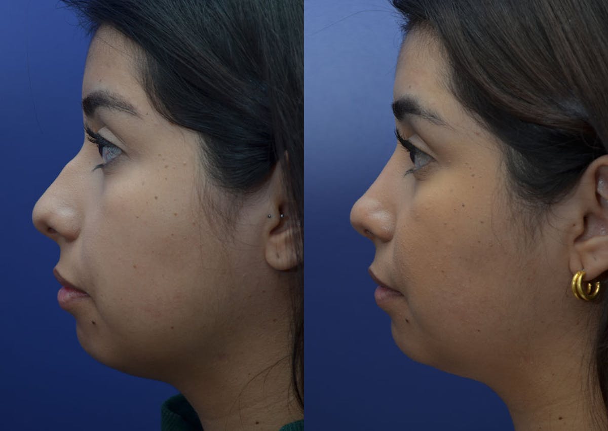 Rhinoplasty Before & After Gallery - Patient 244844 - Image 3