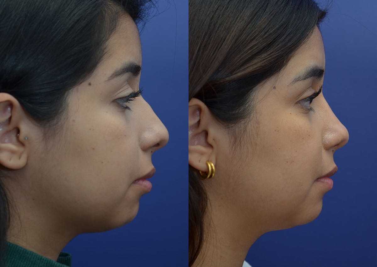 Rhinoplasty Before & After Gallery - Patient 244844 - Image 4