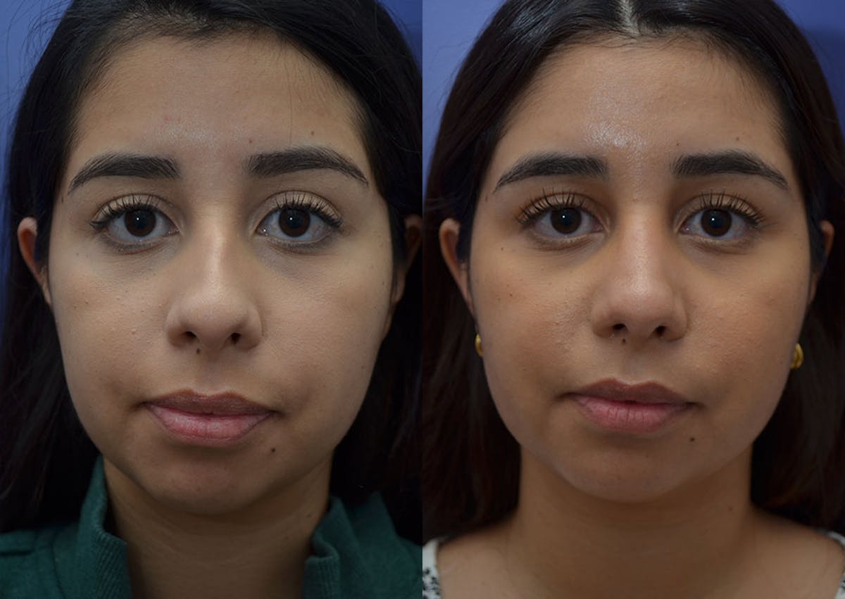 Rhinoplasty Before & After Gallery - Patient 244844 - Image 5