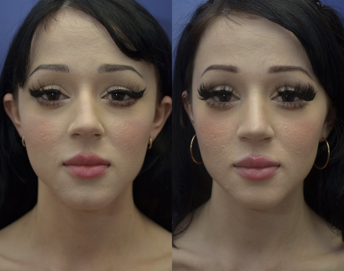 Rhinoplasty (Nose Reshaping Before & After Gallery - Patient 417219 - Image 2