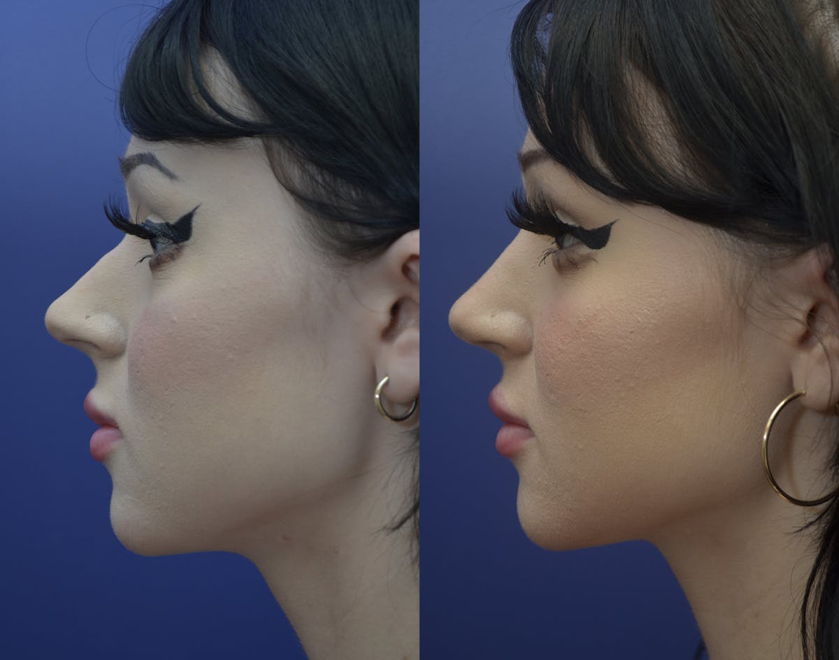 Rhinoplasty (Nose Reshaping Before & After Gallery - Patient 417219 - Image 3