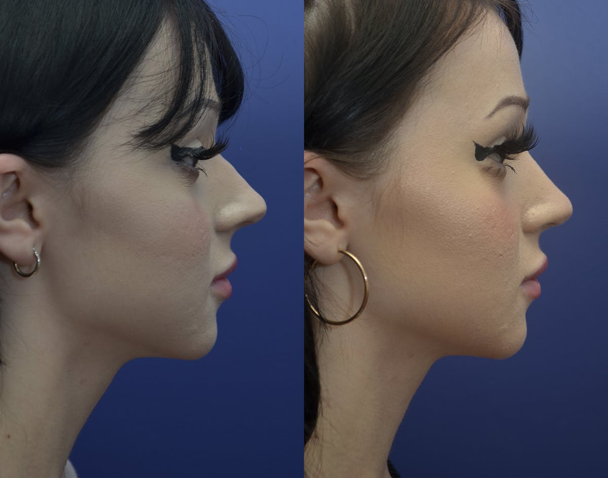 Rhinoplasty (Nose Reshaping Before & After Gallery - Patient 417219 - Image 5
