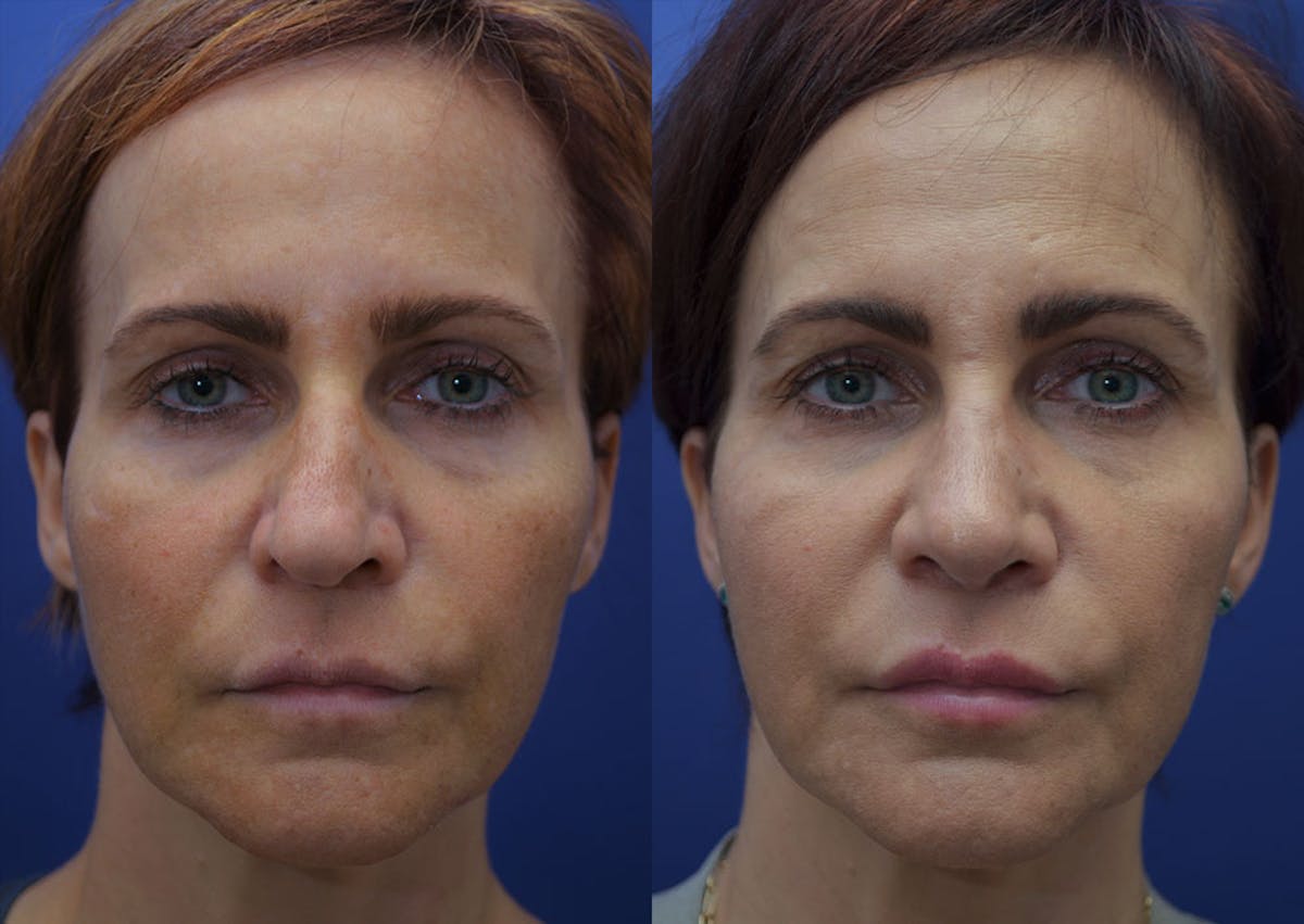 Rhinoplasty Before & After Gallery - Patient 256444 - Image 1