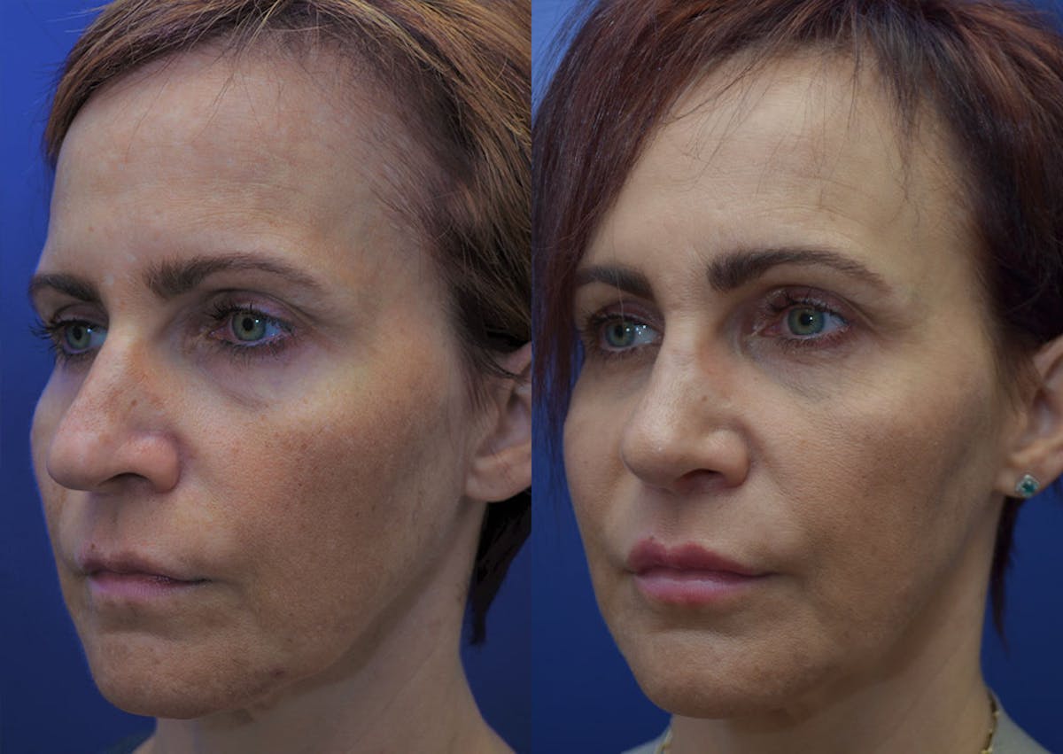 Rhinoplasty Before & After Gallery - Patient 256444 - Image 3