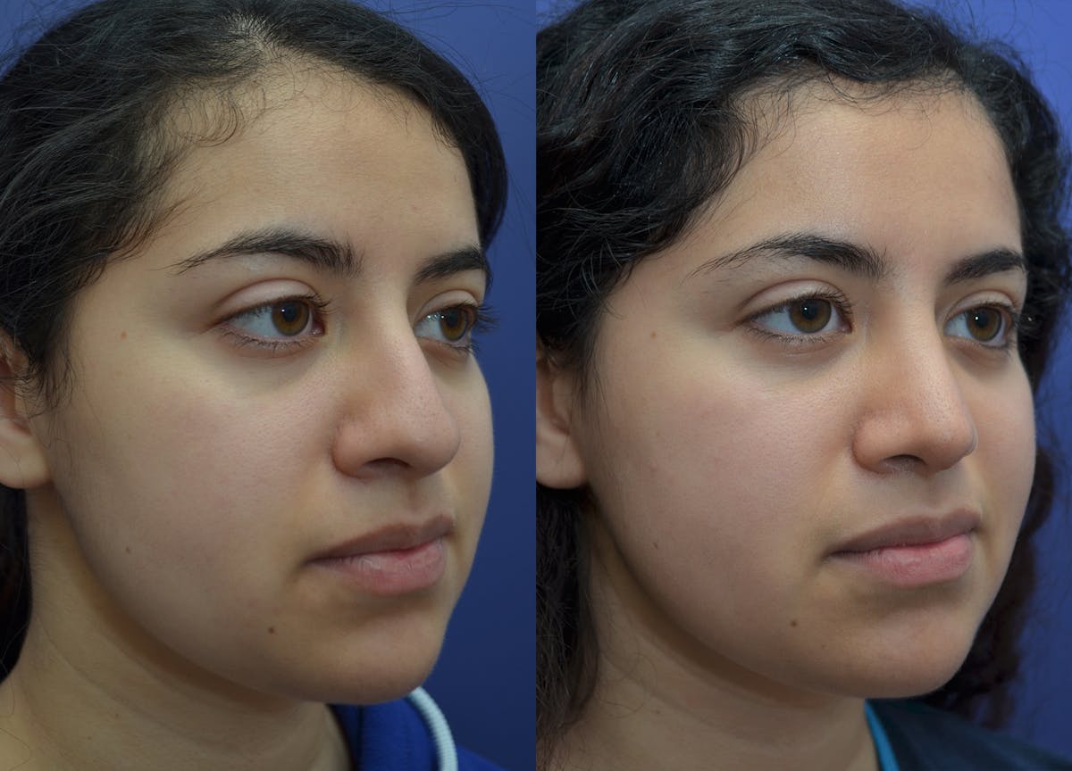Rhinoplasty Before & After Gallery - Patient 320975 - Image 1