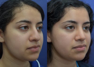 Rhinoplasty Before & After Gallery - Patient 320975 - Image 1