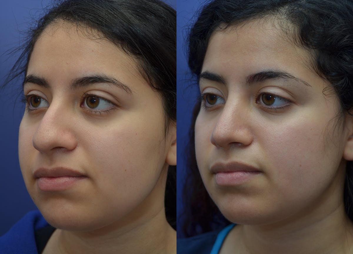Rhinoplasty Before & After Gallery - Patient 320975 - Image 2