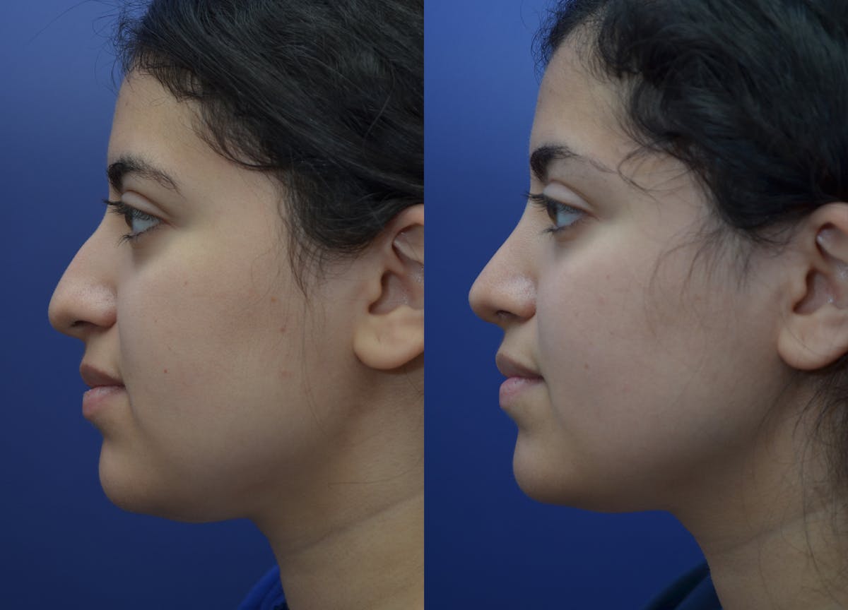 Rhinoplasty Before & After Gallery - Patient 320975 - Image 4