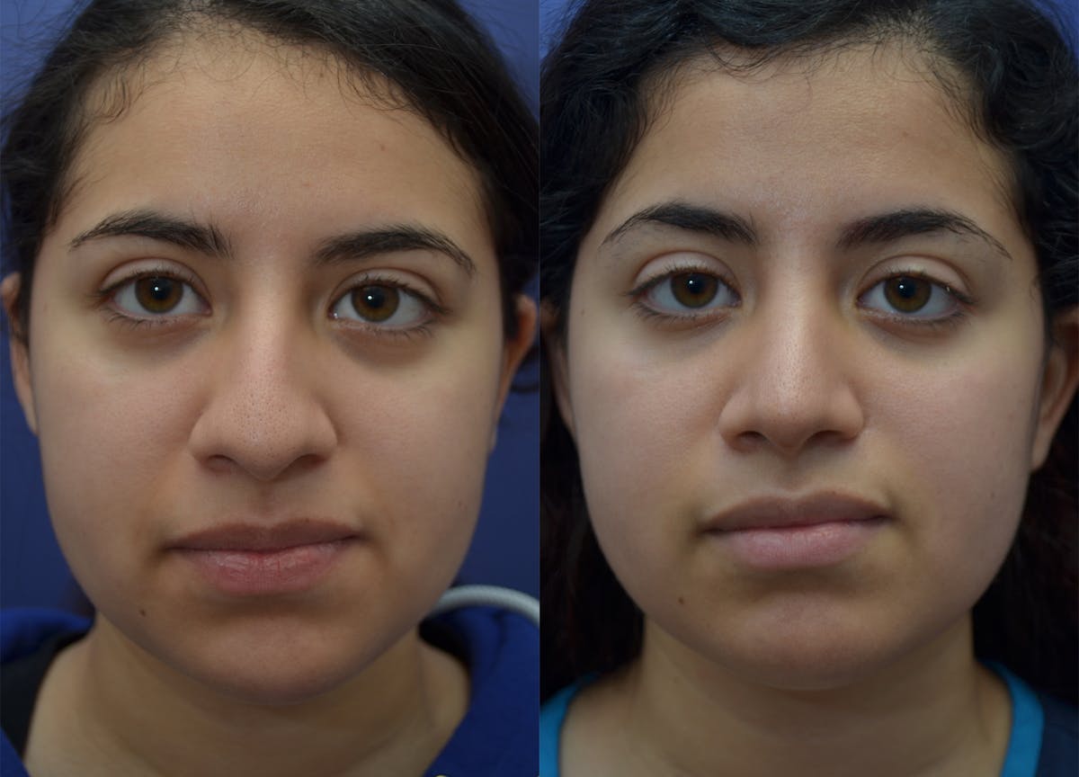 Rhinoplasty Before & After Gallery - Patient 320975 - Image 5
