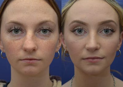 Rhinoplasty Before & After Gallery - Patient 353822 - Image 1
