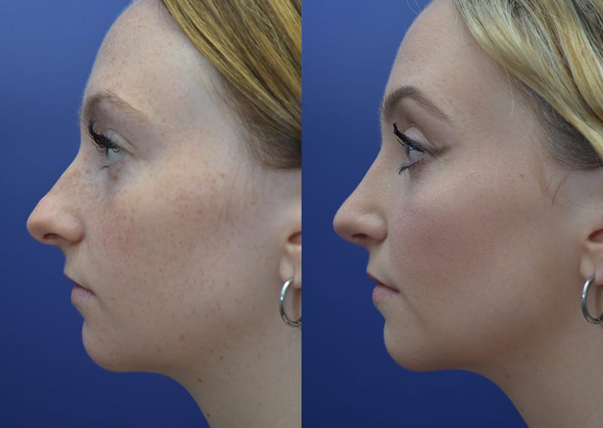 Rhinoplasty Before & After Gallery - Patient 353822 - Image 3