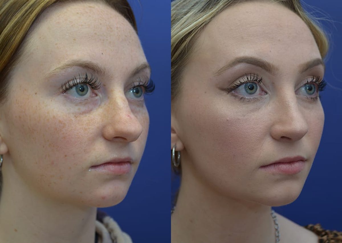 Rhinoplasty Before & After Gallery - Patient 353822 - Image 4