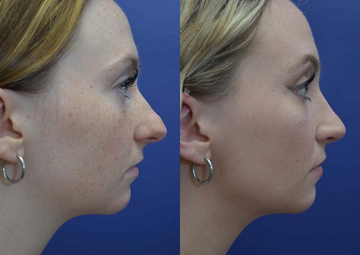 Rhinoplasty Before & After Gallery - Patient 353822 - Image 5