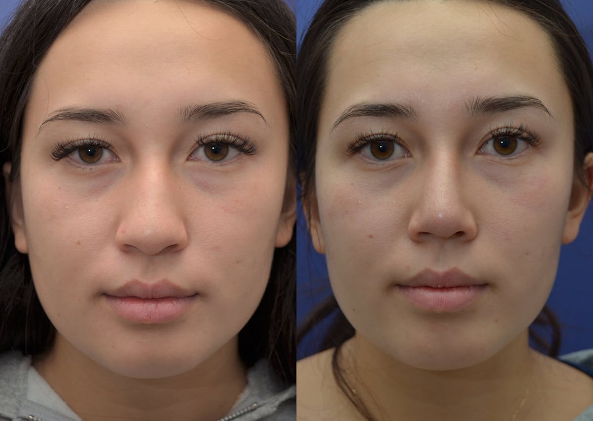 Rhinoplasty (Nose Reshaping Before & After Gallery - Patient 488153 - Image 1