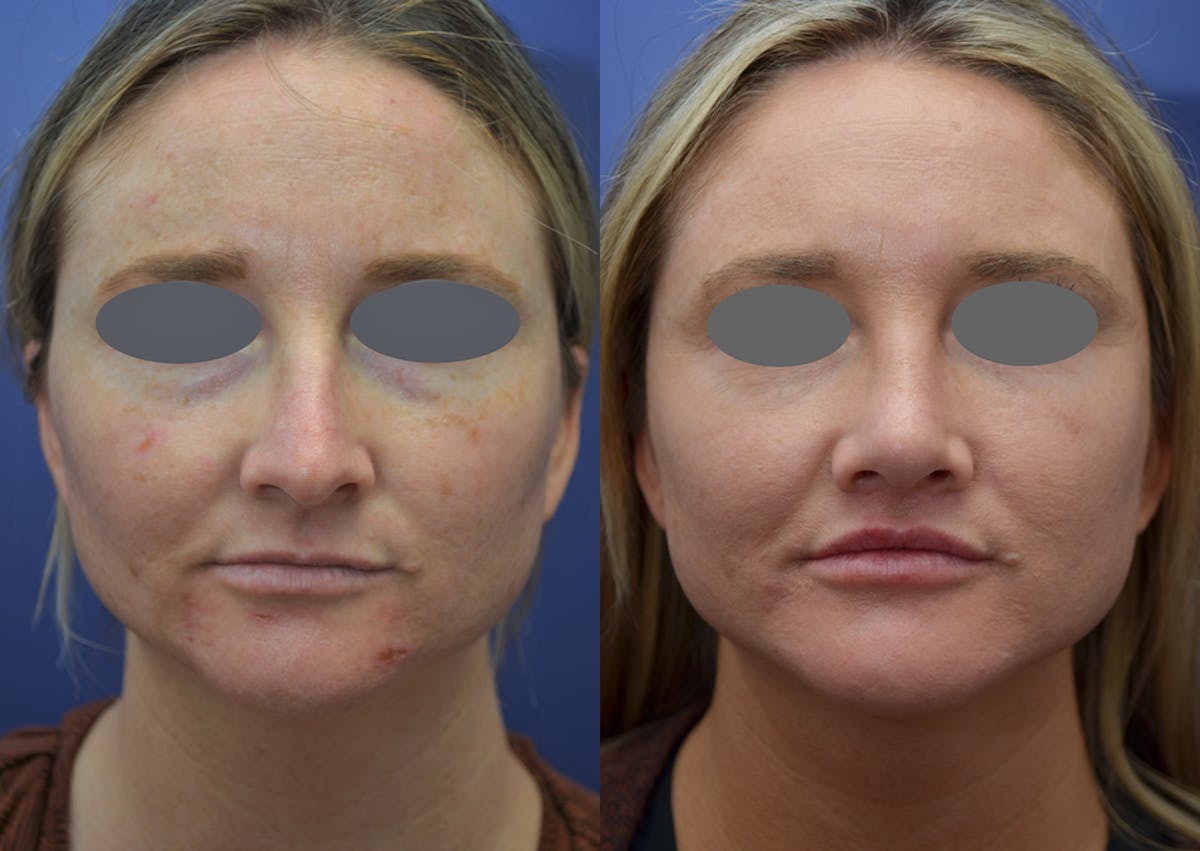 Rhinoplasty Before & After Gallery - Patient 215636 - Image 1