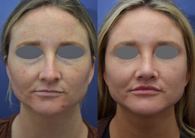 Rhinoplasty Before & After Gallery - Patient 215636 - Image 1