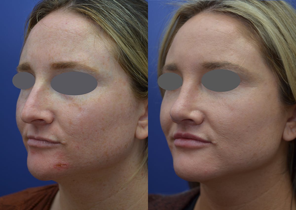Rhinoplasty Before & After Gallery - Patient 215636 - Image 2