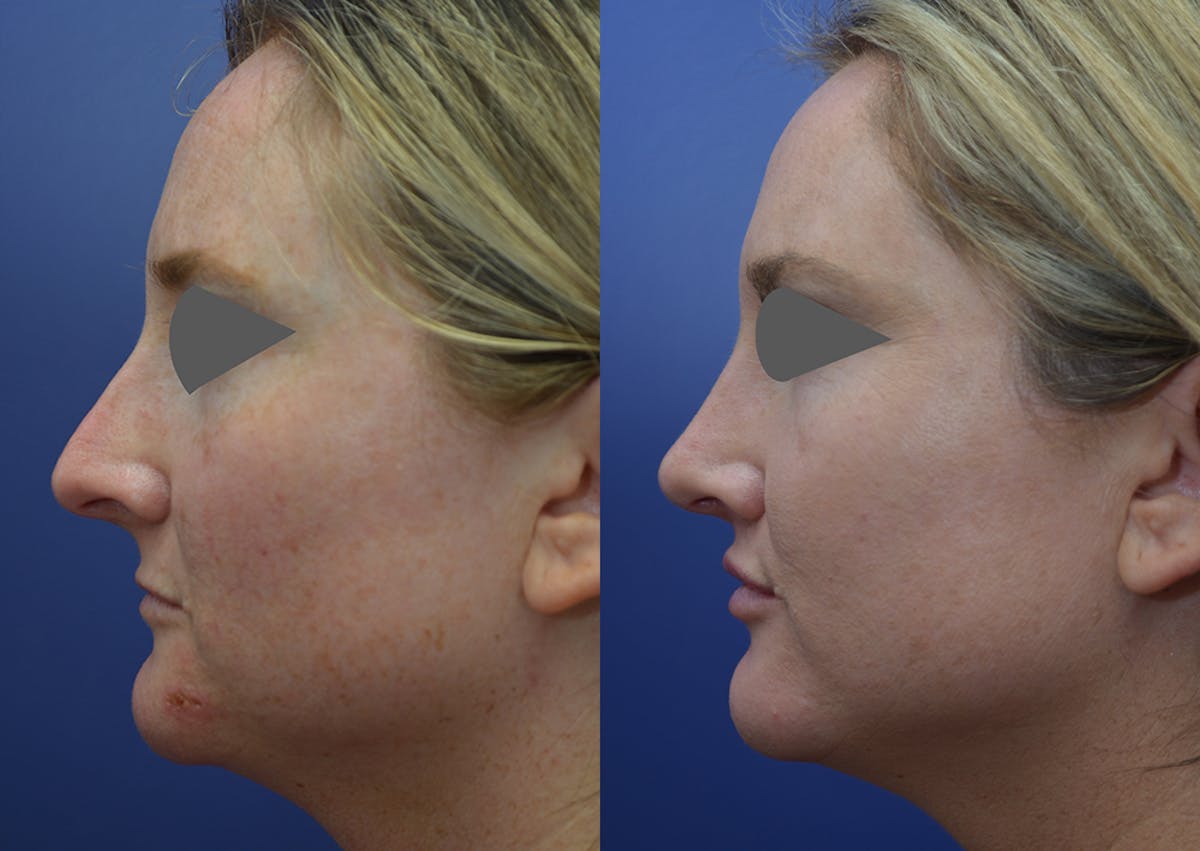 Rhinoplasty Before & After Gallery - Patient 215636 - Image 3