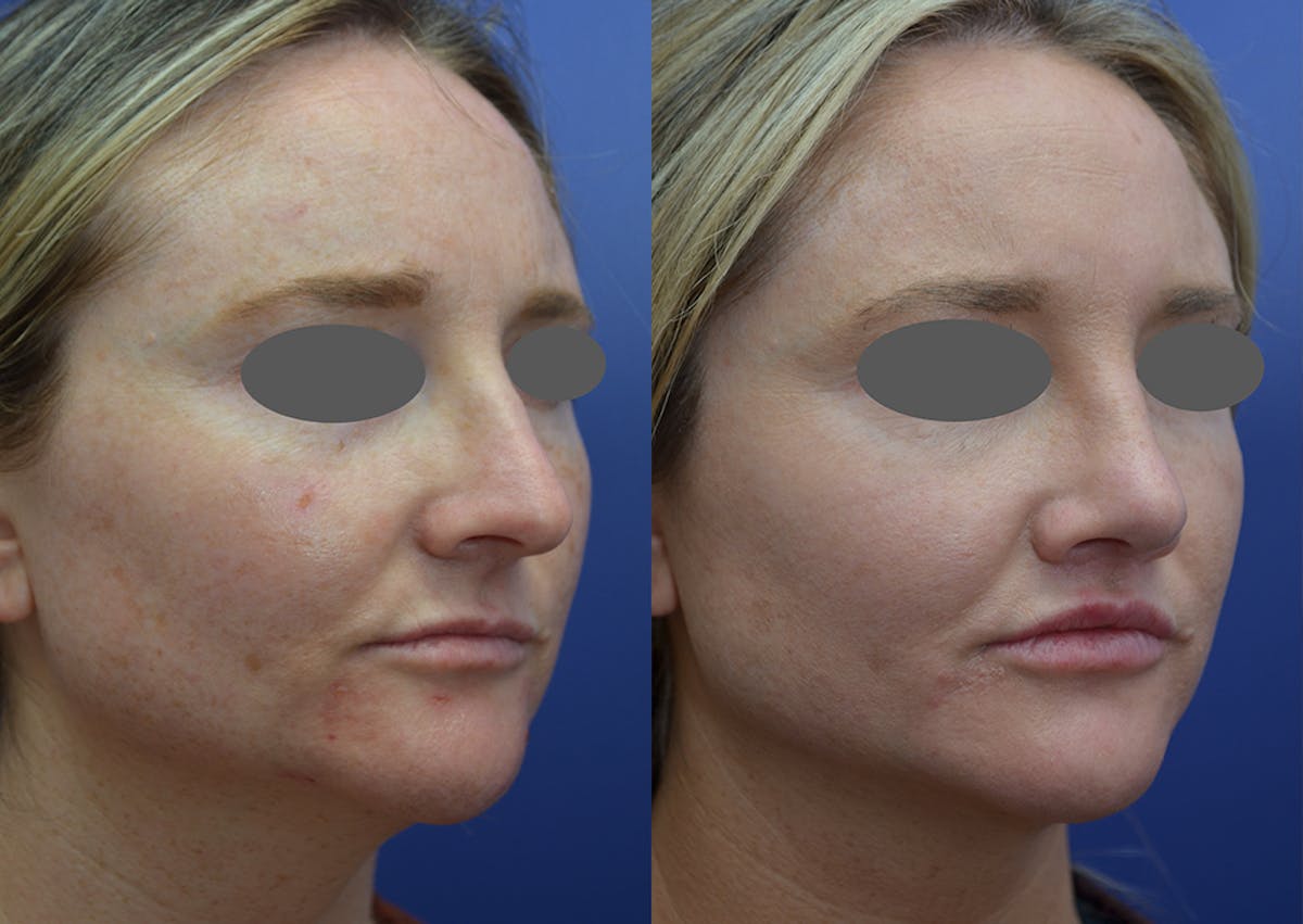 Rhinoplasty Before & After Gallery - Patient 215636 - Image 4