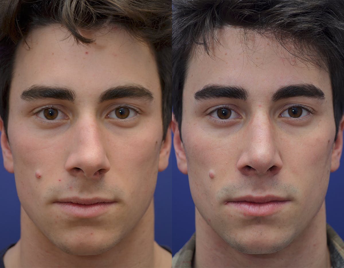 Rhinoplasty Before & After Gallery - Patient 719220 - Image 1