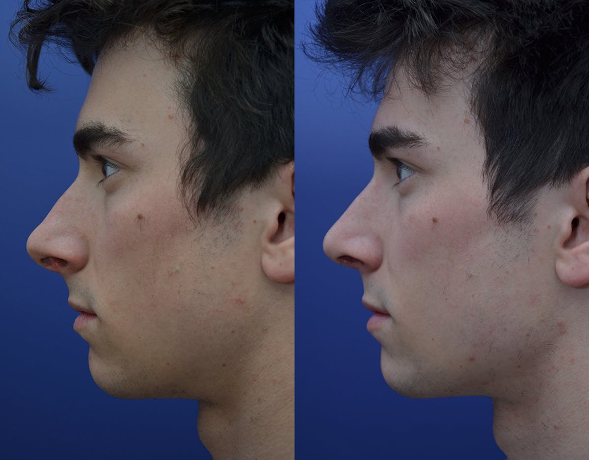 Rhinoplasty Before & After Gallery - Patient 719220 - Image 3
