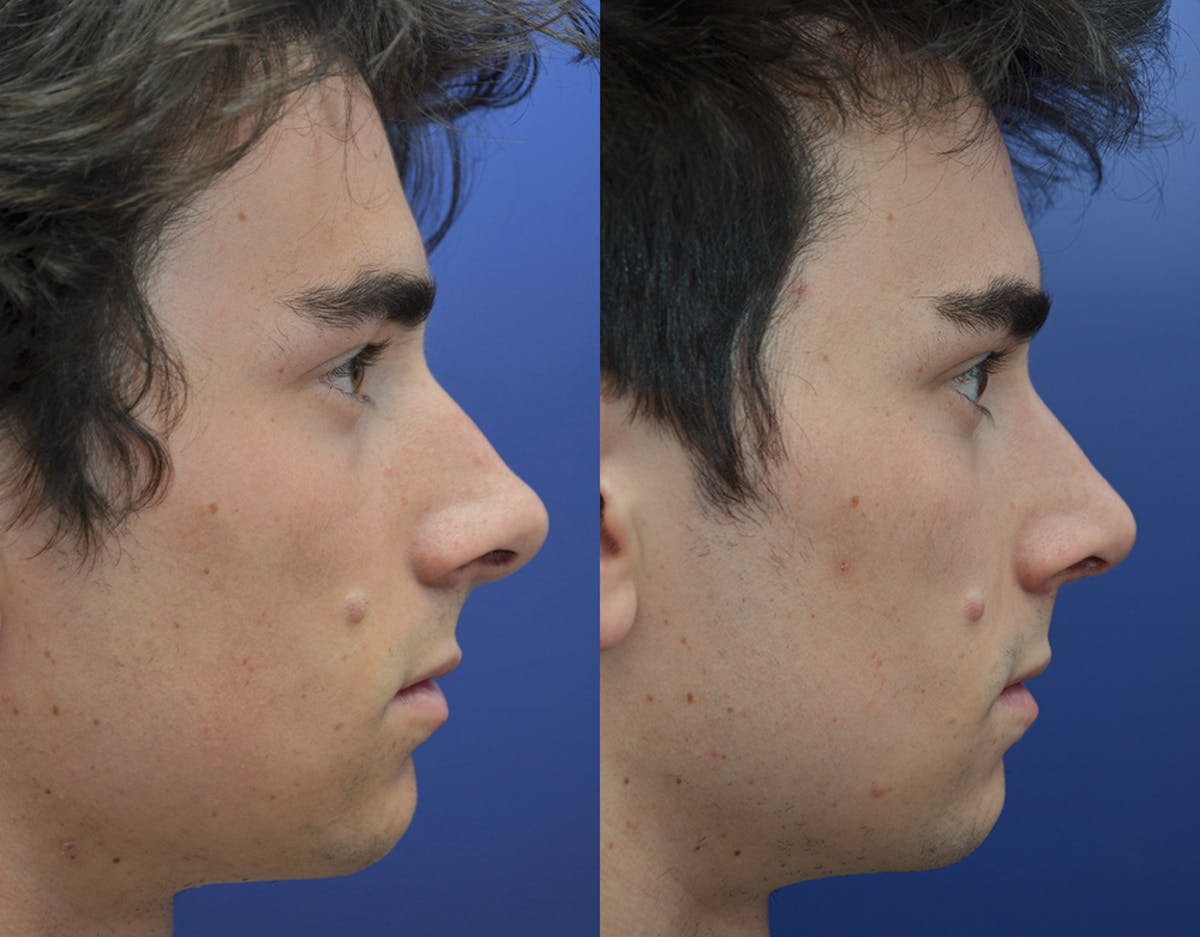 Rhinoplasty Before & After Gallery - Patient 719220 - Image 5