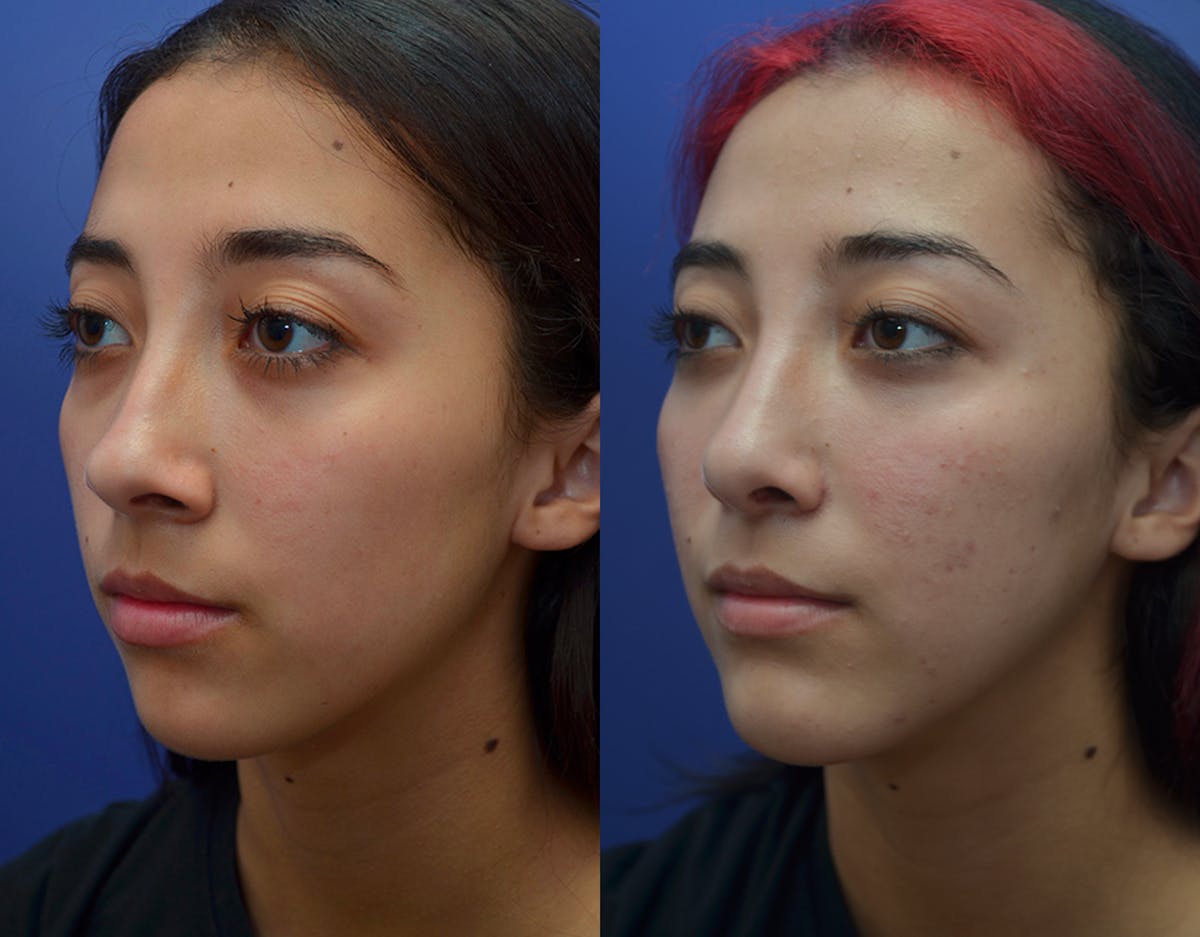 Rhinoplasty Before & After Gallery - Patient 250315 - Image 1