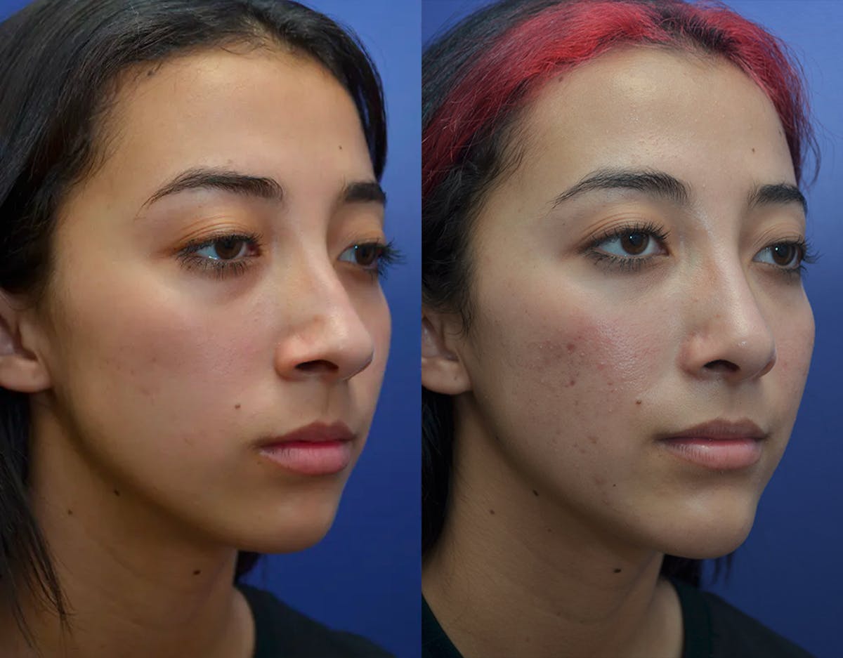 Rhinoplasty Before & After Gallery - Patient 250315 - Image 3