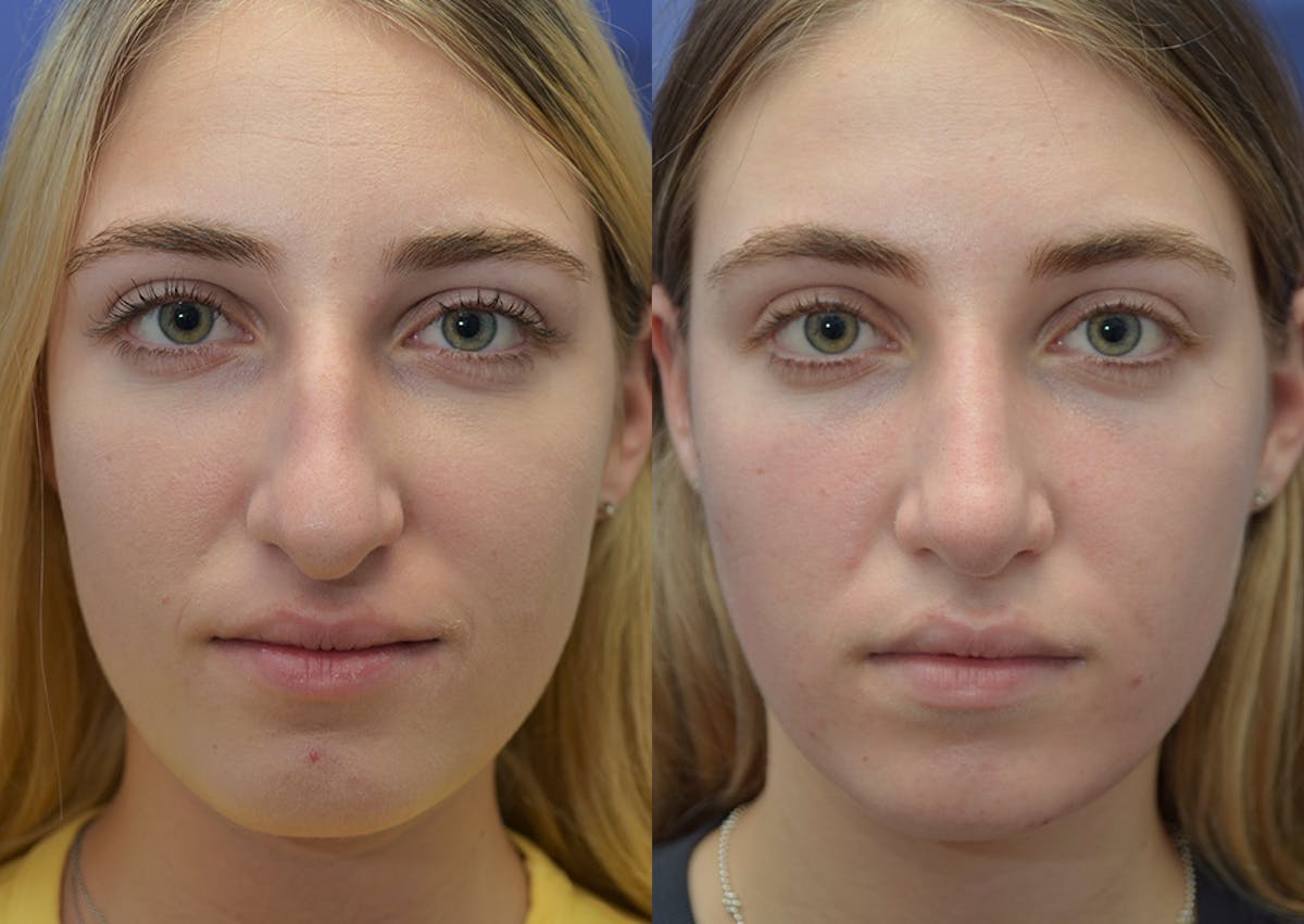 Rhinoplasty Before & After Gallery - Patient 324519 - Image 1