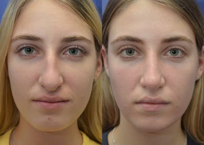 Rhinoplasty Before & After Gallery - Patient 324519 - Image 1