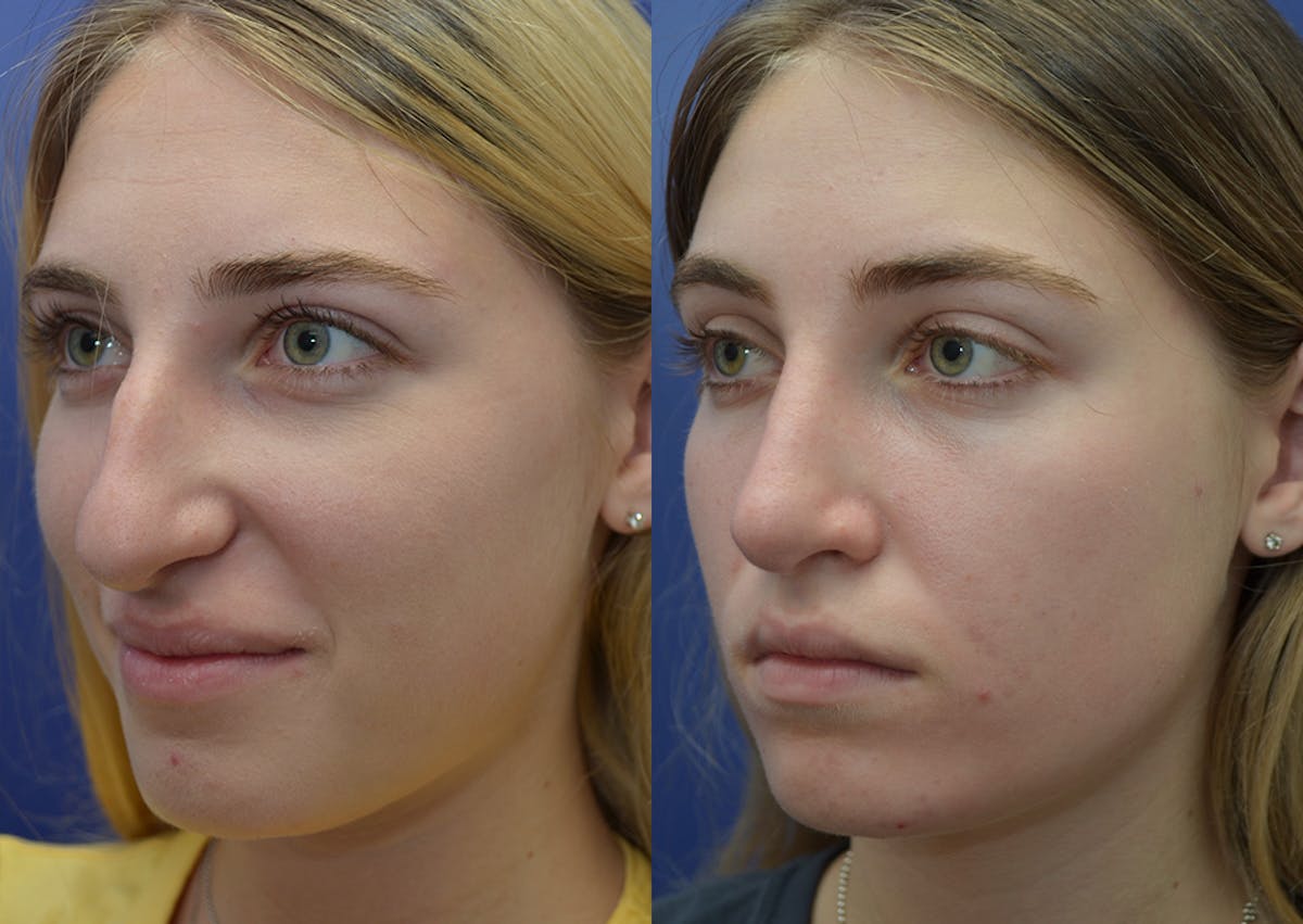 Rhinoplasty Before & After Gallery - Patient 324519 - Image 2