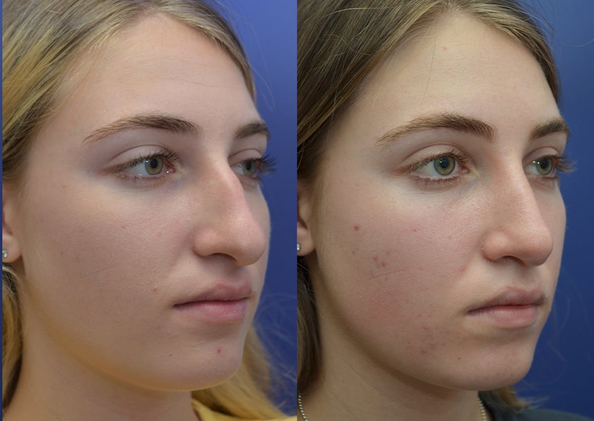 Rhinoplasty Before & After Gallery - Patient 324519 - Image 4