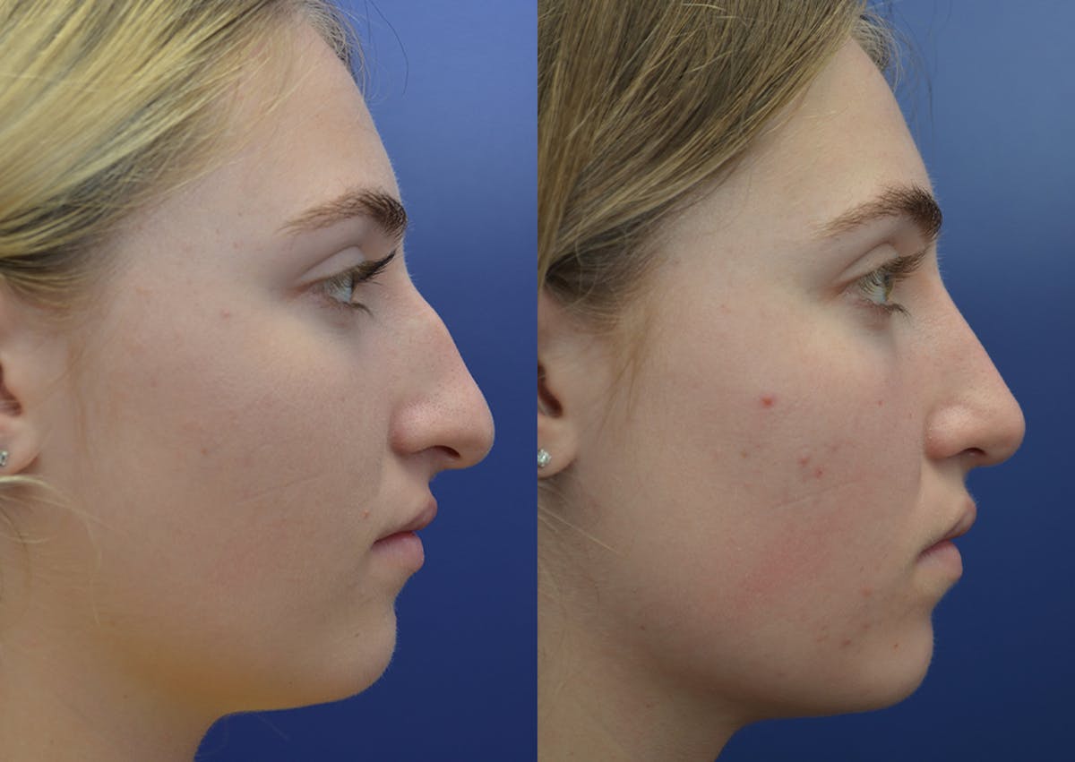 Rhinoplasty Before & After Gallery - Patient 324519 - Image 5