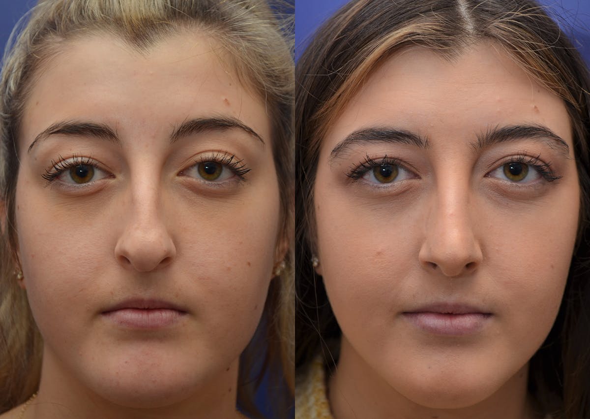 Rhinoplasty (Nose Reshaping Before & After Gallery - Patient 205769 - Image 1