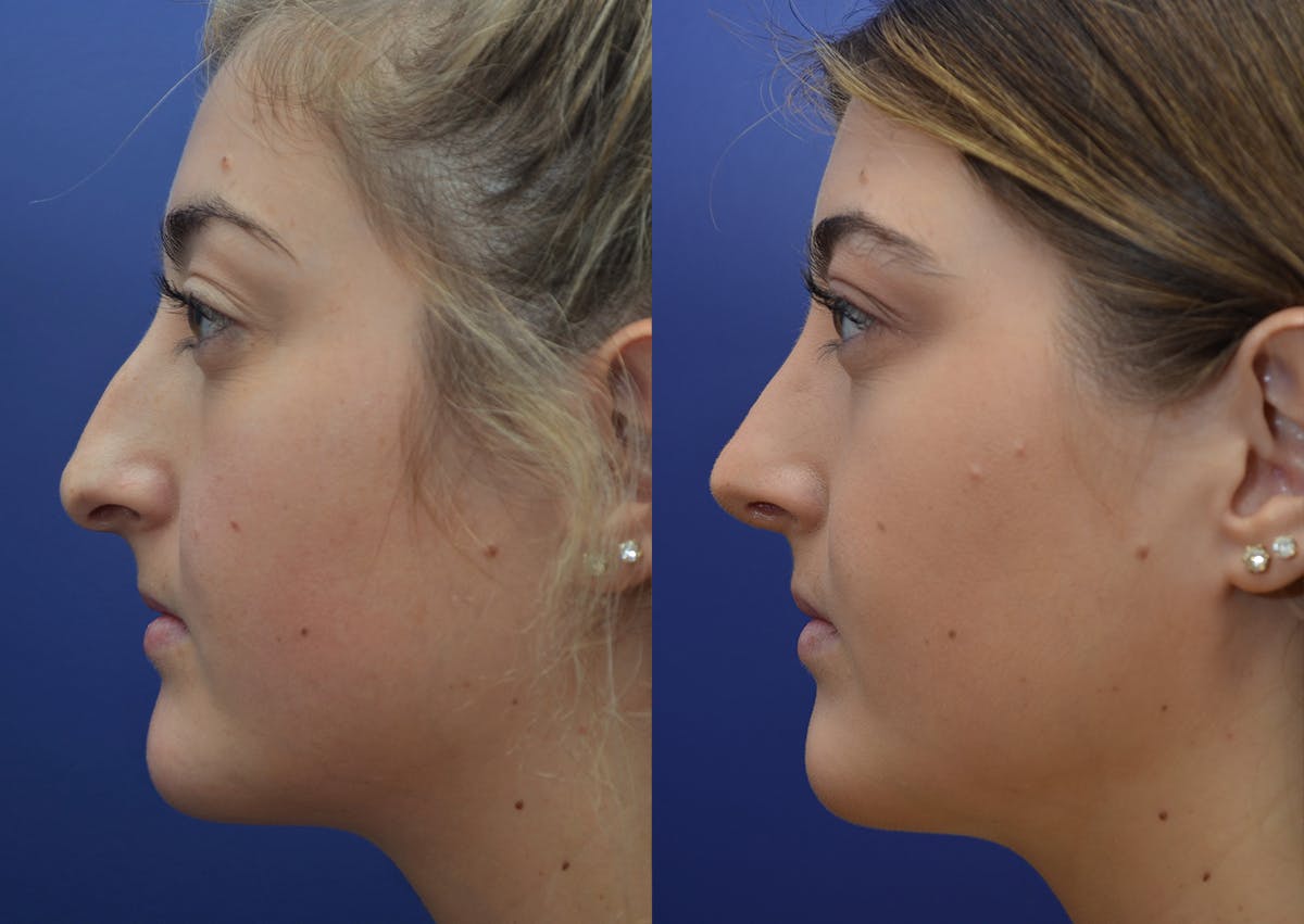 Rhinoplasty (Nose Reshaping Before & After Gallery - Patient 205769 - Image 3