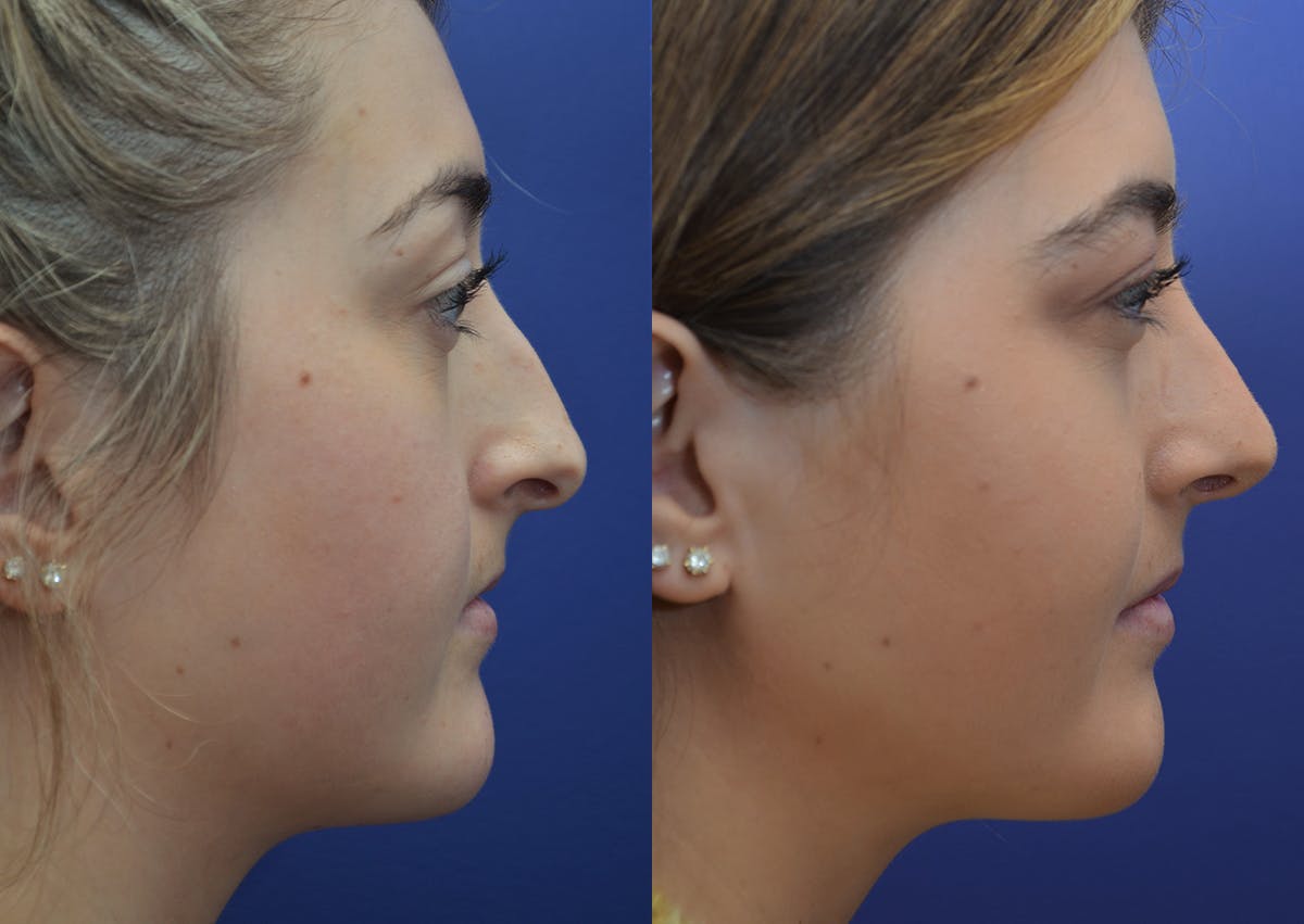 Rhinoplasty (Nose Reshaping Before & After Gallery - Patient 205769 - Image 5