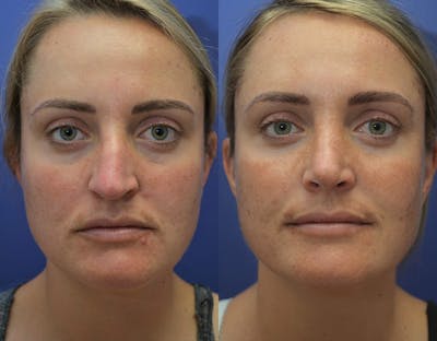 Rhinoplasty Before & After Gallery - Patient 130396 - Image 1