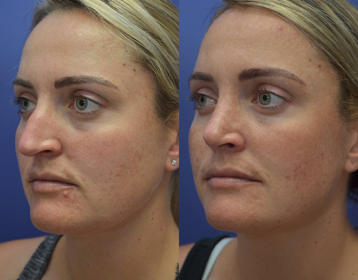 Rhinoplasty Before & After Gallery - Patient 130396 - Image 2