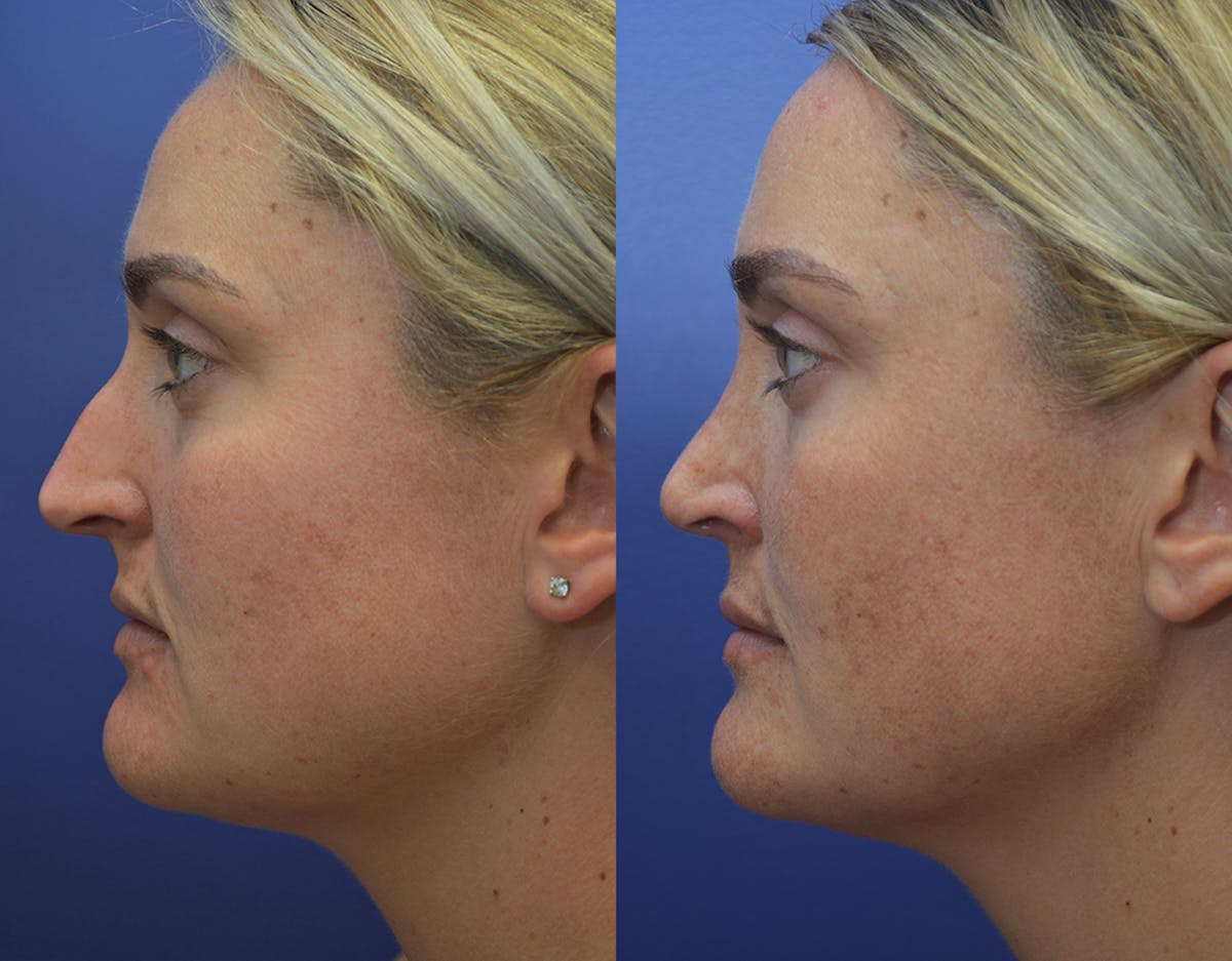 Rhinoplasty Before & After Gallery - Patient 130396 - Image 3