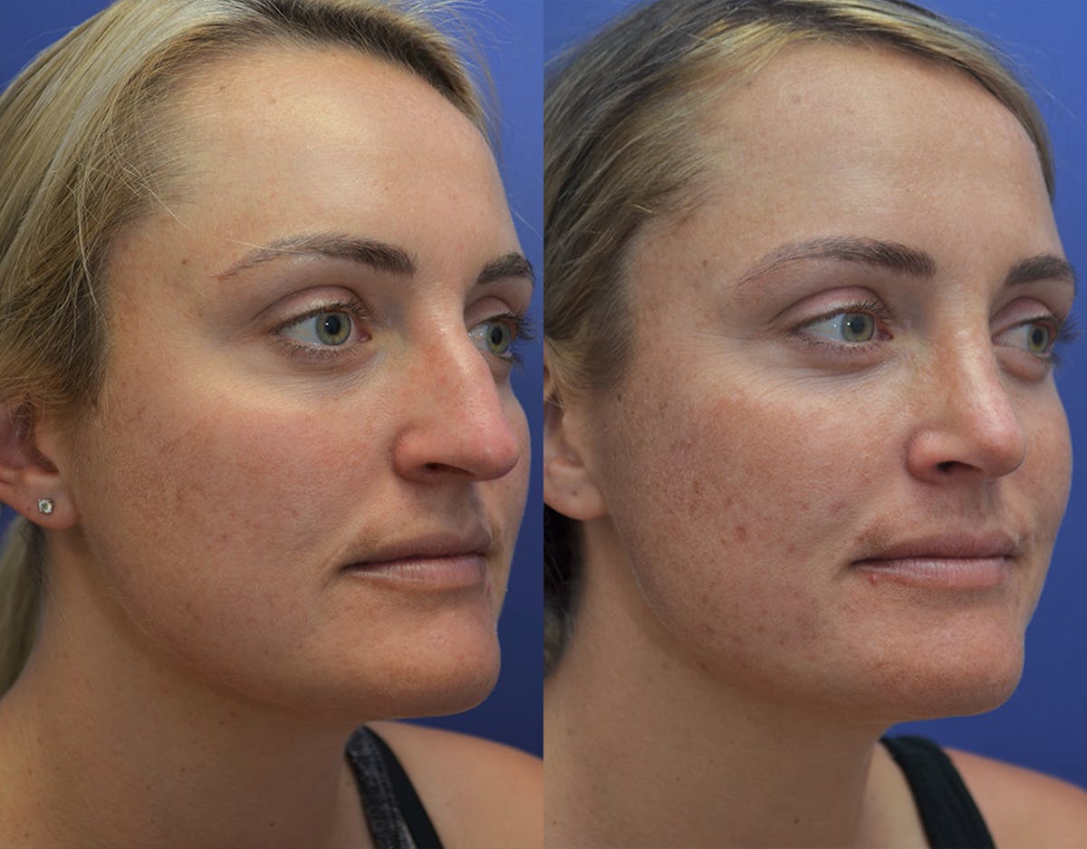 Rhinoplasty Before & After Gallery - Patient 130396 - Image 4
