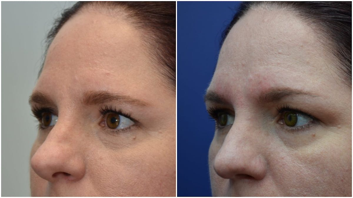 Rhinoplasty Before & After Gallery - Patient 162235 - Image 4
