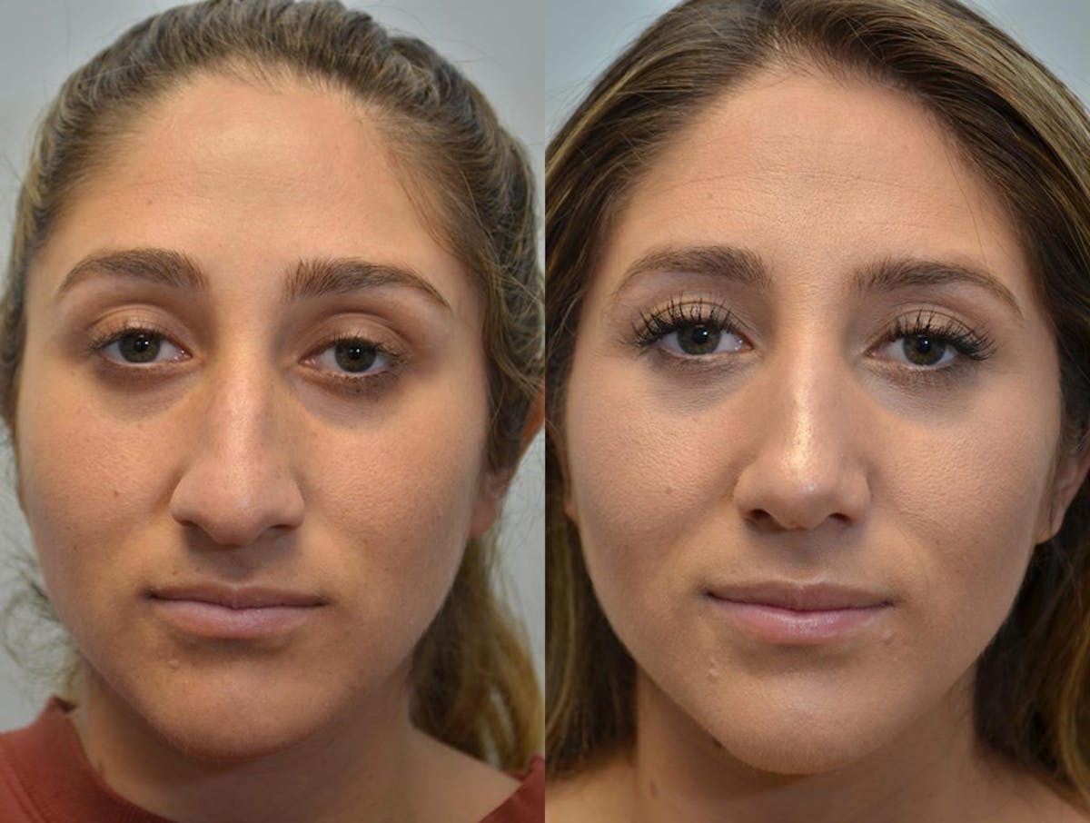 Rhinoplasty Before & After Gallery - Patient 160770 - Image 1