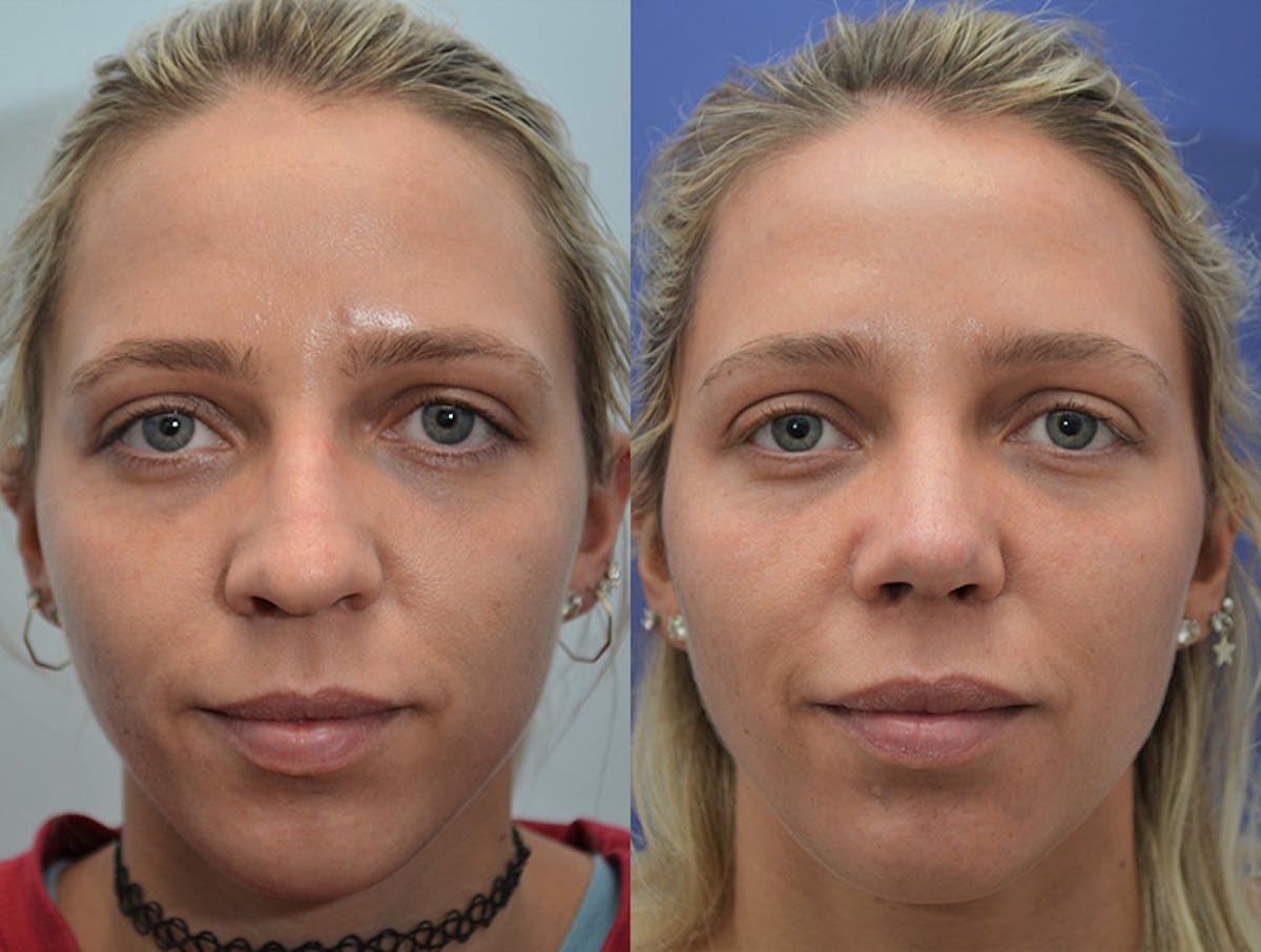 Rhinoplasty Before & After Gallery - Patient 289354 - Image 1