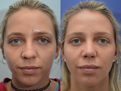 Rhinoplasty Before & After Gallery - Patient 289354 - Image 1