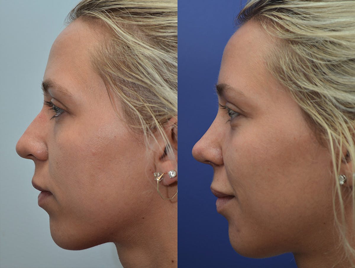 Rhinoplasty Before & After Gallery - Patient 289354 - Image 2