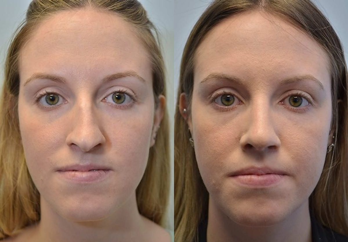 Rhinoplasty Before & After Gallery - Patient 254607 - Image 1